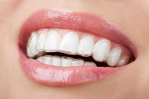 Invisalign Braces For Adults | My Local Dentists Northmead