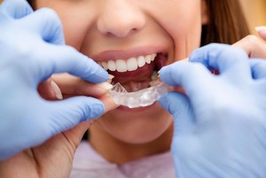 Invisalign Braces For Adults