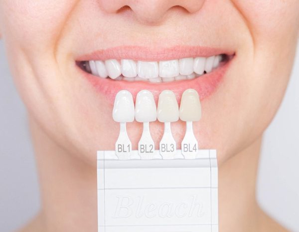 composite veneers northmead