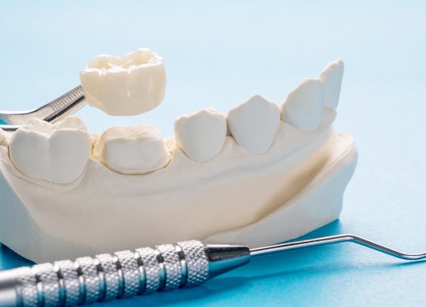 dental crowns and bridges northmead