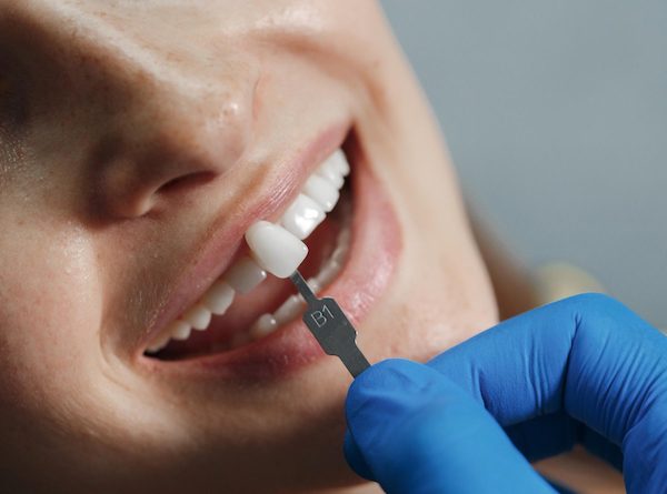 dental veneers northmead