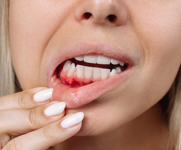 gum disease northmead