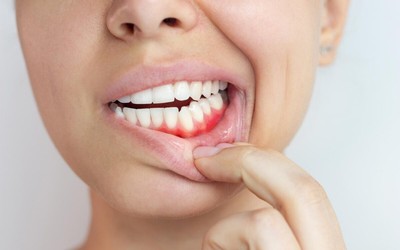 How Gum Disease Can Lead To Other Health Issues
