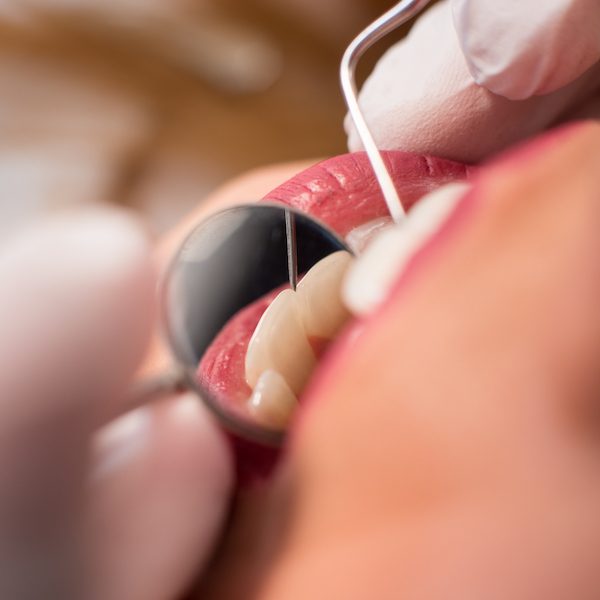 tooth fillings northmead