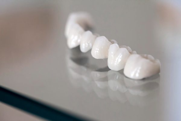 what are the benefits of a dental bridge northmead