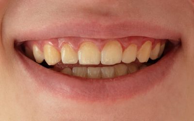 3 Types of Tooth Discolouration: Causes, Prevention & Treatment
