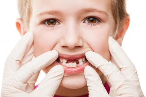 Types and Causes of Teeth Cavities