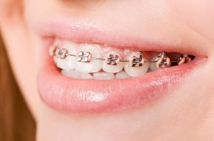 Smiles First Dental | Orthodontics | Dentist Northmead