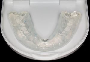 Smiles First Dental | Teeth Grinding | Dentist Northmead