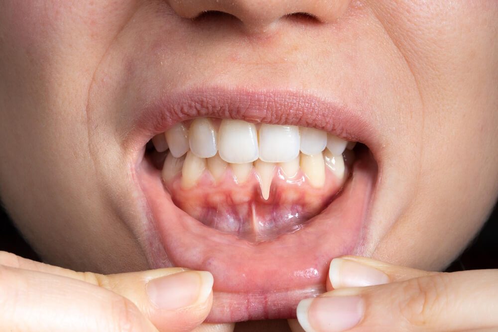 Curing Gum Disease Symptoms, Causes, Prevention, and Treatment Options