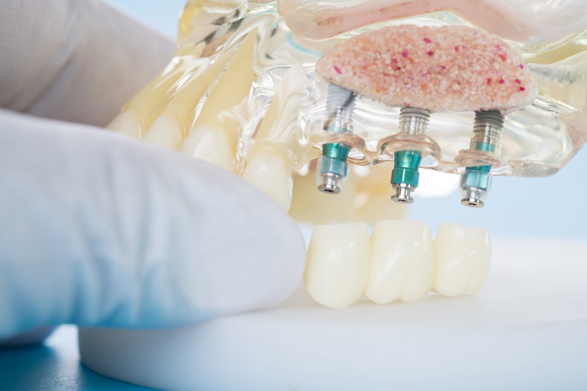 Dental Implants in Northmead: Should You Shop Around?