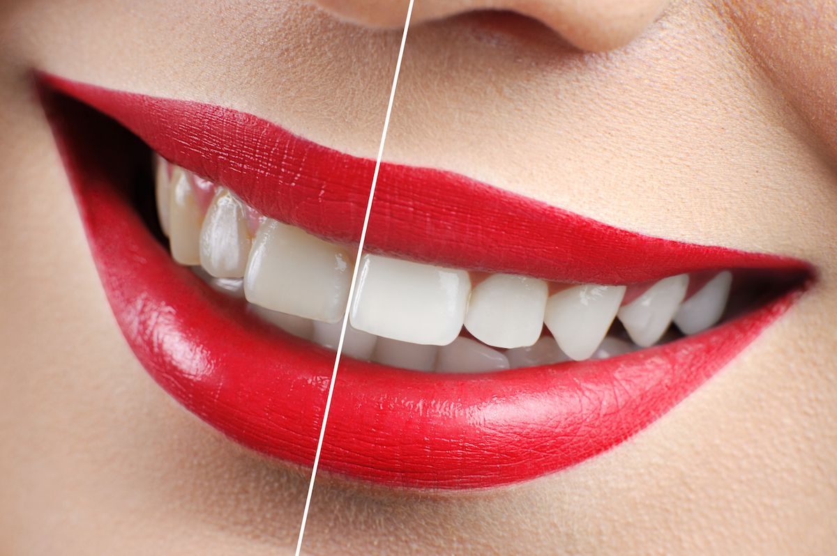 Whitening Your Smile – We’re Partners!