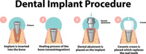 dental implant noosa