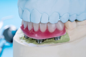 dental-implant-noosa