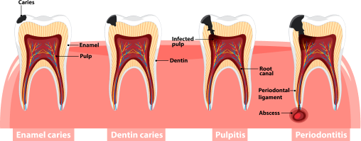 stages of tooth decay